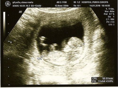 Tecniche innovative per individuare delle complicazioni in gravidanza