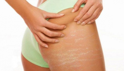 Smagliature: il corpo dopo il parto cambia