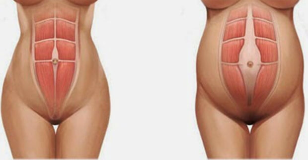 La diastasi addominale in una donna incinta (a destra)