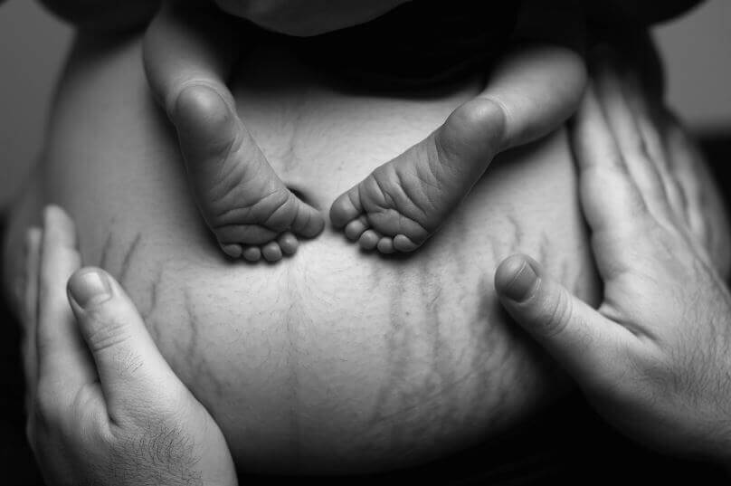 pancia con smagliature e piedi di neonato