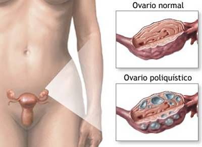 Sindrome dell'ovaio policistico.