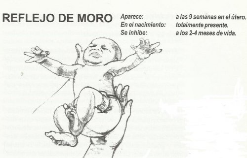 Riflesso di Moro.