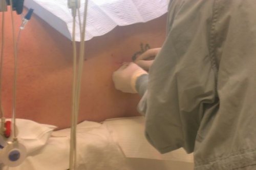 Anestesia epidurale o spinale?
