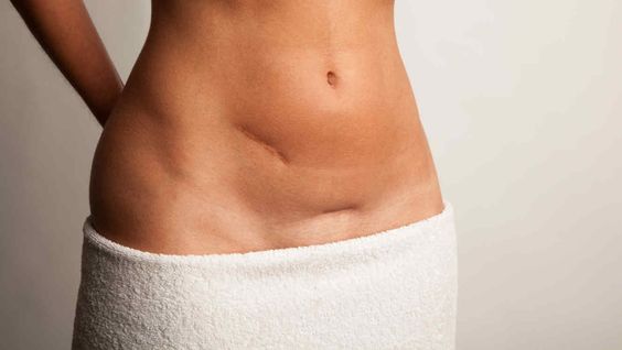 Cicatrice da parto cesareo