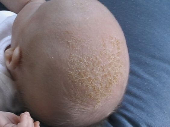 Crosta lattea: le squame sulla pelle dei bambini