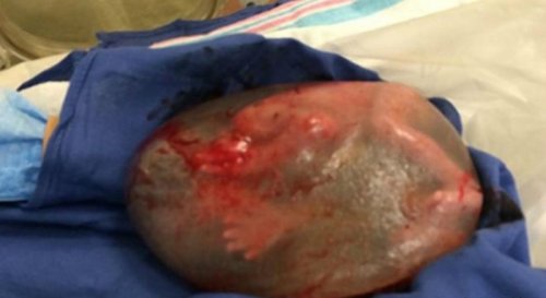 sacco amniotico intatto