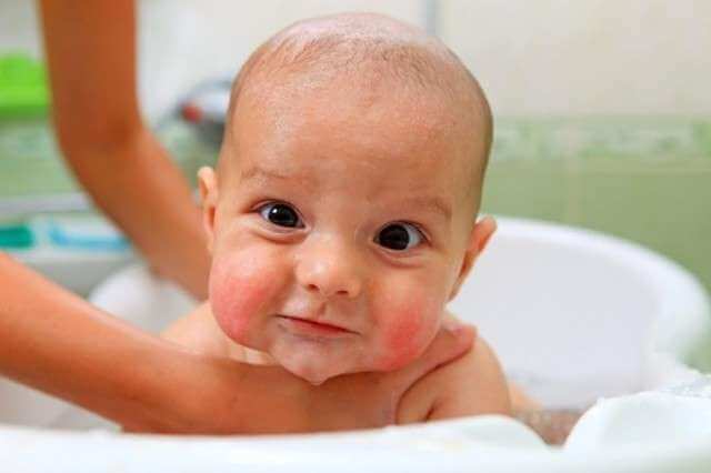 Dermatite atopica nei bebè