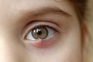 Orzaiolo nei bambini: cosa fare e come curarlo