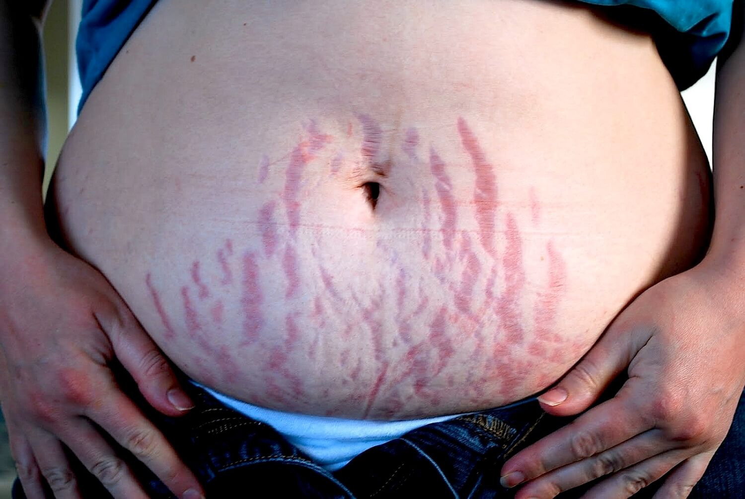 Smagliature durante la gravidanza