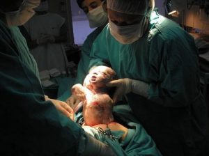 L'effetto del taglio cesareo sul corpo della donna