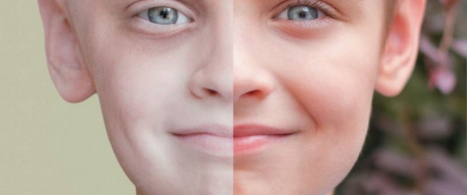 La leucemia infantile si manifesta attraverso numerosi cambiamenti della pelle