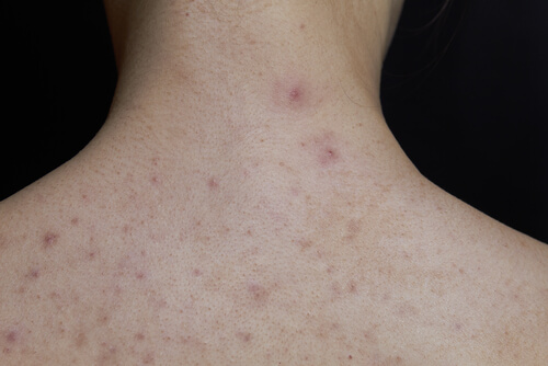 La scarlattina nei bambini si manifesta con un esantema