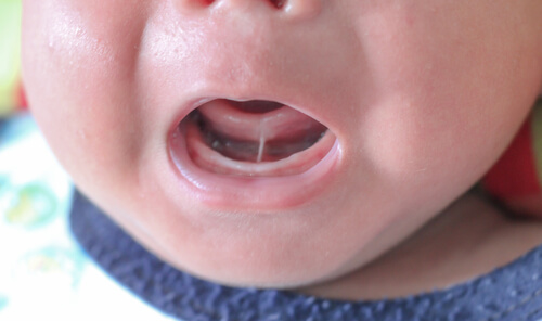 Anchiloglossia o frenulo linguale corto nel bambino