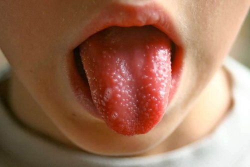 La lingua a fragola è uno dei sintomi della scarlattina nei bambini