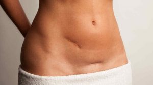 Curare le cicatrici: i nostri migliori consigli