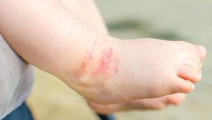 Dermatite atopica nei bebè: 15 consigli per curare la pelle