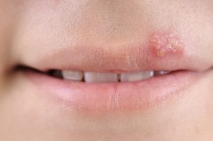 Herpes nei bambini: sintomi, cause e trattamento