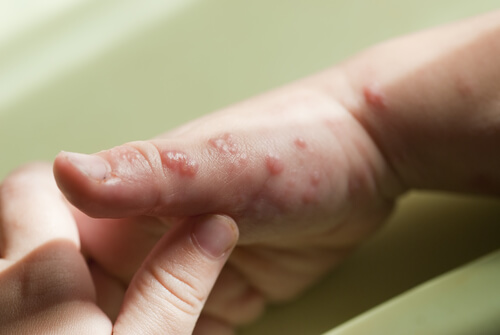 Herpes nei bambini mani