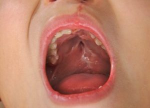 Palatoschisi nei bambini: tutto quello che c'è da sapere