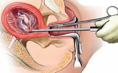 Il raschiamento è un intervento chirurgico attraverso il quale una massa anomala viene rimossa dalla cavità uterina.