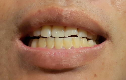 Macchie dentarie: come prevenirle