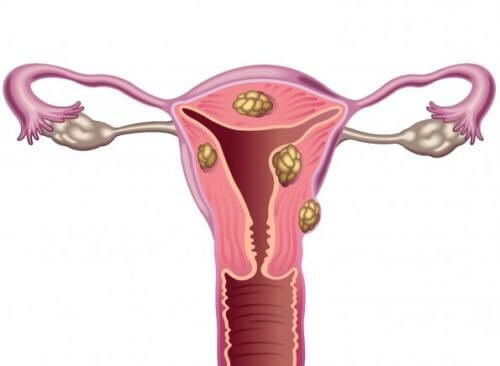 I miomi uterini e l’infertilità