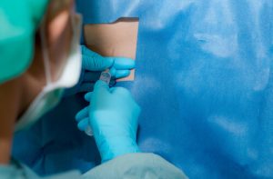 Anestesia spinale e anestesia epidurale: quali sono le differenze?