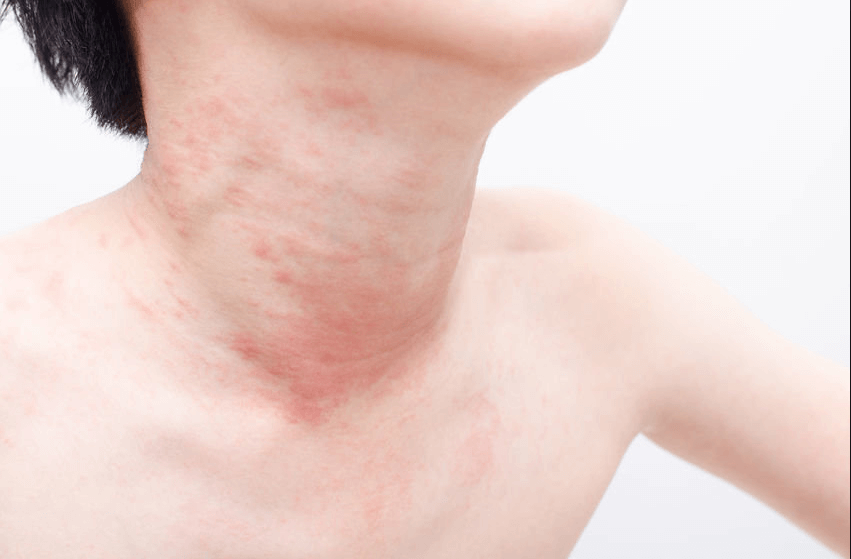 L'orticaria cronica è il risultato di un insieme di alterazioni che si verificano a livello dell'epidermide