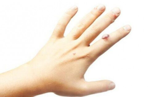 Rimedi casalinghi contro le verruche possono essere l'aceto di mele o il succo di cipolla