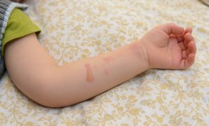 Cosa faccio se mio figlio si ustiona con l'acqua bollente?