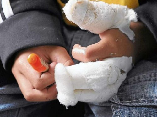 Ustione in un bambino