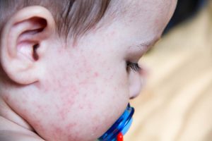 Allergie alimentari più comuni nei bambini