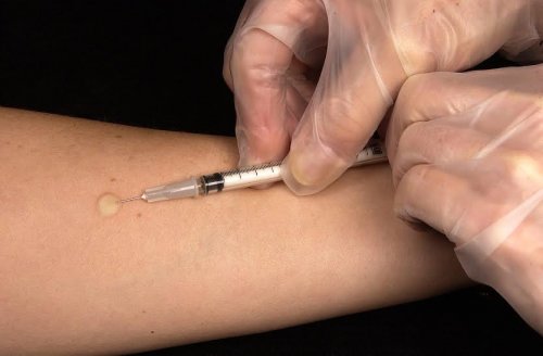 Cosa dovete sapere sulla sindrome di Guillain-Barré