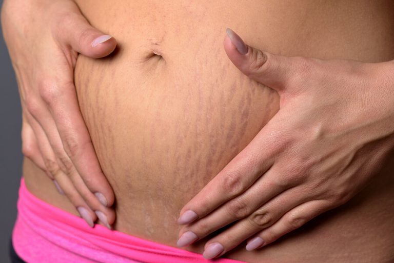 Come eliminare le smagliature durante la gravidanza?