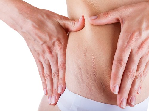 Le smagliature assomigliano alle cicatrici: è impossibile farle scomparire del tutto