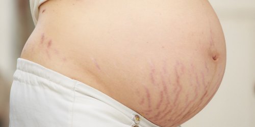 Durante la gravidanza, la pelle subisce intensi stiramenti e presenta delle smagliature