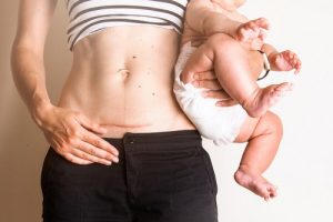 La cura dei punti dopo il parto