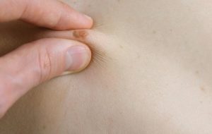 Tipi di nei: come identificarli