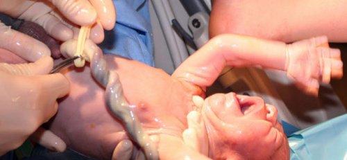 donare il sangue del cordone ombelicale