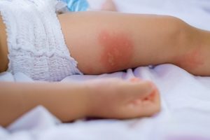 Come trattare la dermatite da pannolino