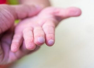 Vesciche nei bambini: come vanno curate?