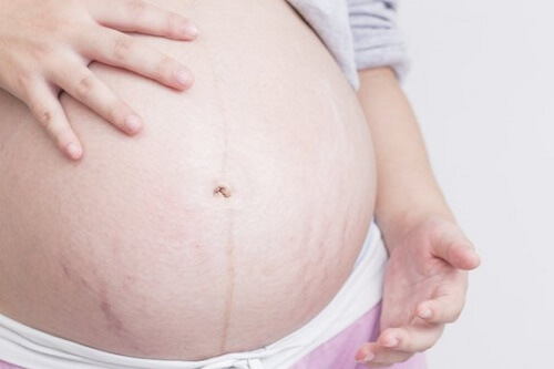 Come prevenire le smagliature durante la gravidanza