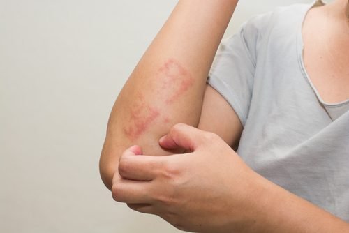 L'aloe vera è uno dei migliori rimedi naturali contro la psoriasi
