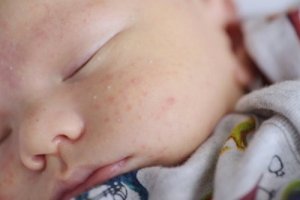 Milia nei neonati: cos'è e come va curata