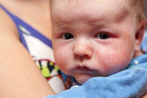impetigine nei bambini