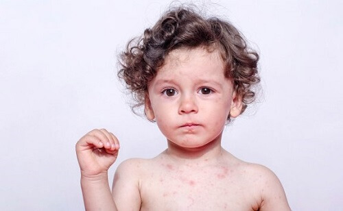 Allergia al sudore nei bambini: tipi e prevenzione
