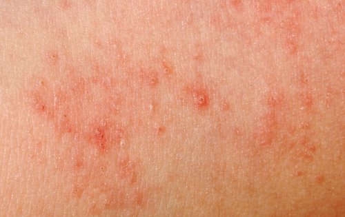 Allergie della pelle