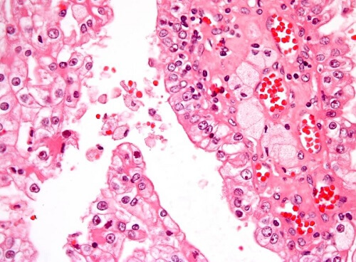 Cellule di tumore ai reni nell'infanzia