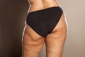 Qualche dritta per combattere la cellulite