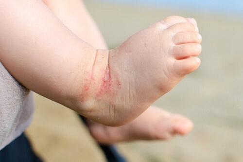Esempio di dermatite atopica nei bambini su un piede